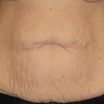 Tummy Tuck Before & After Patient #1139