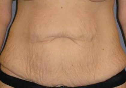 Tummy Tuck Before & After Patient #1139