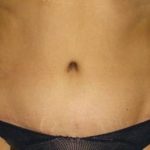 Tummy Tuck Before & After Patient #1146