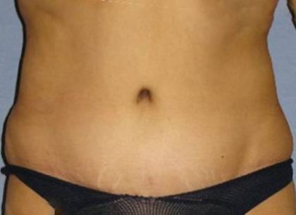 Tummy Tuck Before & After Patient #1146