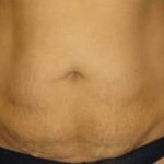 Tummy Tuck Before & After Patient #1146