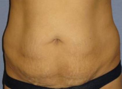 Tummy Tuck Before & After Patient #1146