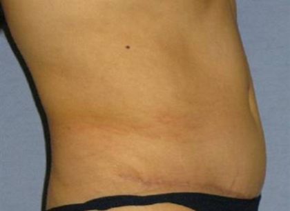 Tummy Tuck Before & After Patient #1146