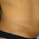 Tummy Tuck Before & After Patient #1146