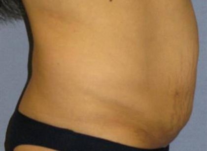 Tummy Tuck Before & After Patient #1146