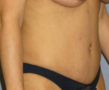 Tummy Tuck Before & After Patient #1151
