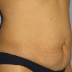 Tummy Tuck Before & After Patient #1151