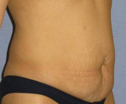 Tummy Tuck Before & After Patient #1151