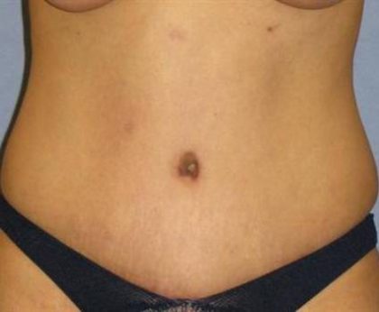 Tummy Tuck Before & After Patient #1151