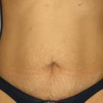 Tummy Tuck Before & After Patient #1151