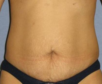 Tummy Tuck Before & After Patient #1151