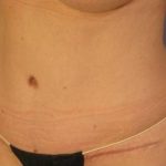 Tummy Tuck Before & After Patient #1158