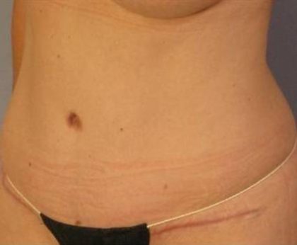 Tummy Tuck Before & After Patient #1158