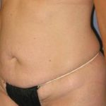 Tummy Tuck Before & After Patient #1158