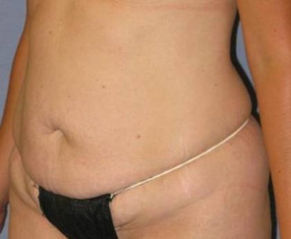 Tummy Tuck Before & After Patient #1158
