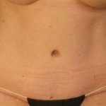 Tummy Tuck Before & After Patient #1158