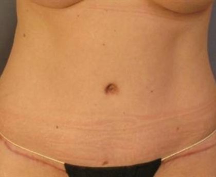 Tummy Tuck Before & After Patient #1158