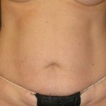 Tummy Tuck Before & After Patient #1158