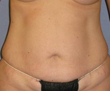 Tummy Tuck Before & After Patient #1158