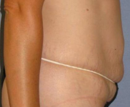 Tummy Tuck Before & After Patient #1158