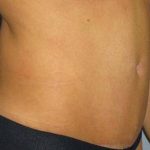 Tummy Tuck Before & After Patient #1177