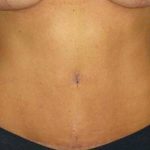 Tummy Tuck Before & After Patient #1177