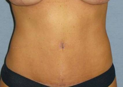 Tummy Tuck Before & After Patient #1177