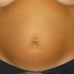 Tummy Tuck Before & After Patient #1177