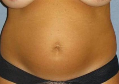 Tummy Tuck Before & After Patient #1177