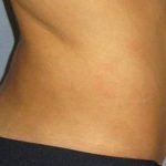 Tummy Tuck Before & After Patient #1177