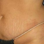 Tummy Tuck Before & After Patient #1200