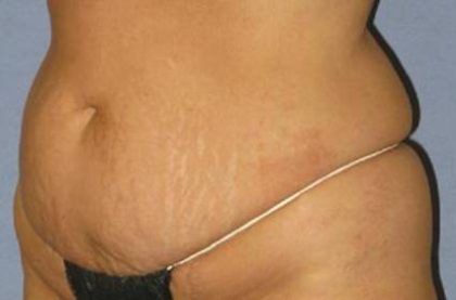 Tummy Tuck Before & After Patient #1200