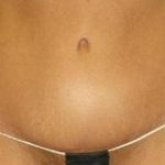 Tummy Tuck Before & After Patient #1200