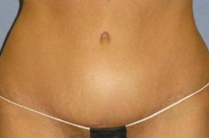 Tummy Tuck Before & After Patient #1200