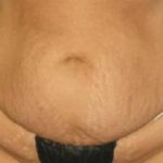 Tummy Tuck Before & After Patient #1200