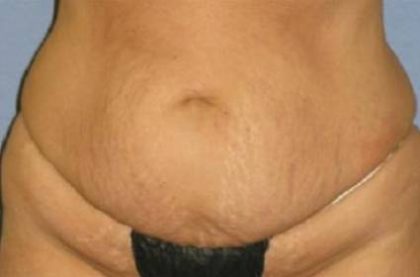 Tummy Tuck Before & After Patient #1200