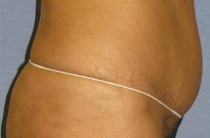 Tummy Tuck Before & After Patient #1200