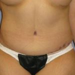 Tummy Tuck Before & After Patient #1214