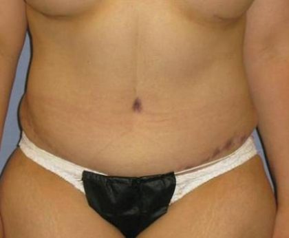 Tummy Tuck Before & After Patient #1214