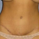 Tummy Tuck Before & After Patient #1226