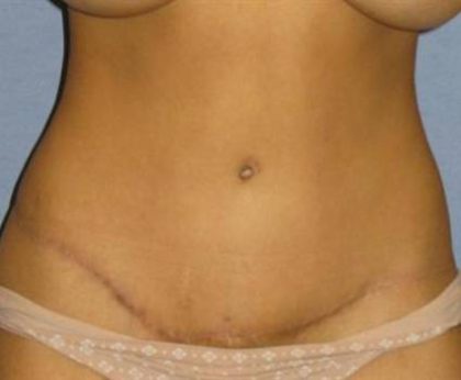 Tummy Tuck Before & After Patient #1226