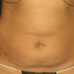 Tummy Tuck Before & After Patient #1226