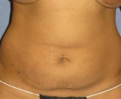 Tummy Tuck Before & After Patient #1226