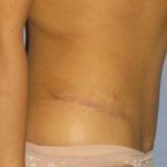 Tummy Tuck Before & After Patient #1226