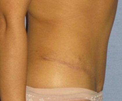 Tummy Tuck Before & After Patient #1226