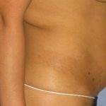 Tummy Tuck Before & After Patient #1226