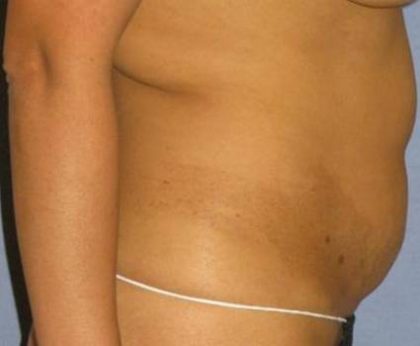 Tummy Tuck Before & After Patient #1226