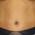 Tummy Tuck Before & After Patient #1231