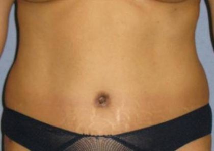 Tummy Tuck Before & After Patient #1231