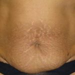 Tummy Tuck Before & After Patient #1231